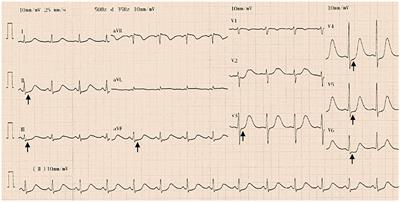 Case Report: Pheochromocytoma in a 59-Year-Old Woman Presenting With Hypotension